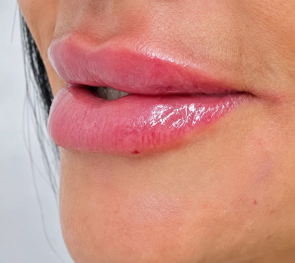 Antes e depois preenchimento labial — lábios com volume e contorno após o preenchimento