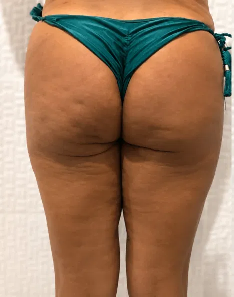 Antes e depois tratamento de celulite — glúteos antes das sessões