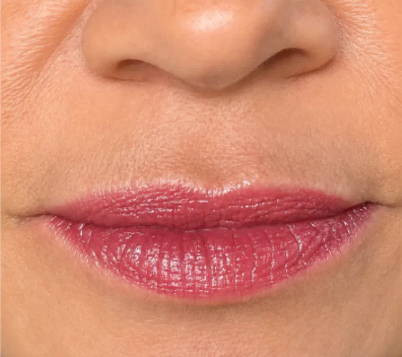 Antes e depois preenchimento labial — lábios antes do procedimento na Estética Carmem Gonzaga