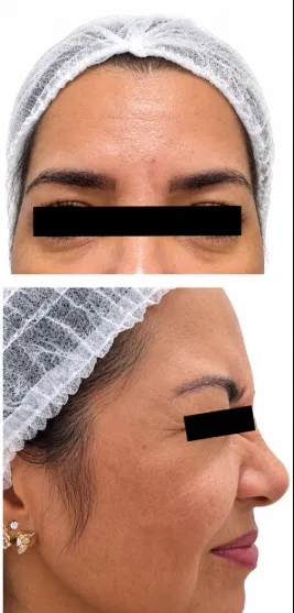 Antes e depois Botox testa — testa lisa após a aplicação de toxina botulínica