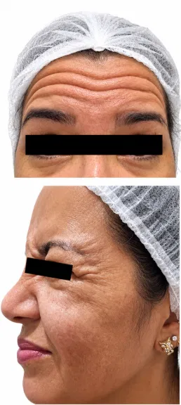 Antes e depois Botox testa — rugas de expressão antes da aplicação